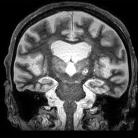 UTSW researchers use focused ultrasound to identify stroke biomarkers