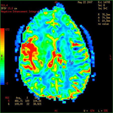 Imaging Brain Vasculature and Brain Perfusion 