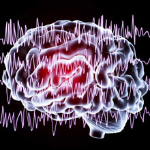 Pediatric Stroke