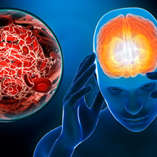 Stroke/Cerebrovascular 