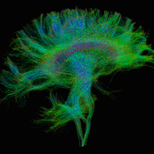 Diffusion Tensor Imaging