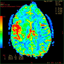 Perfusion Imaging