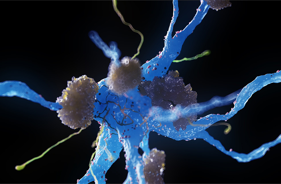 illustration Alzheimers nerve cells
